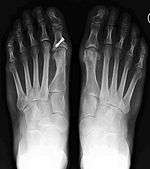 2 years after both feet were corrected with syndemosis procedure